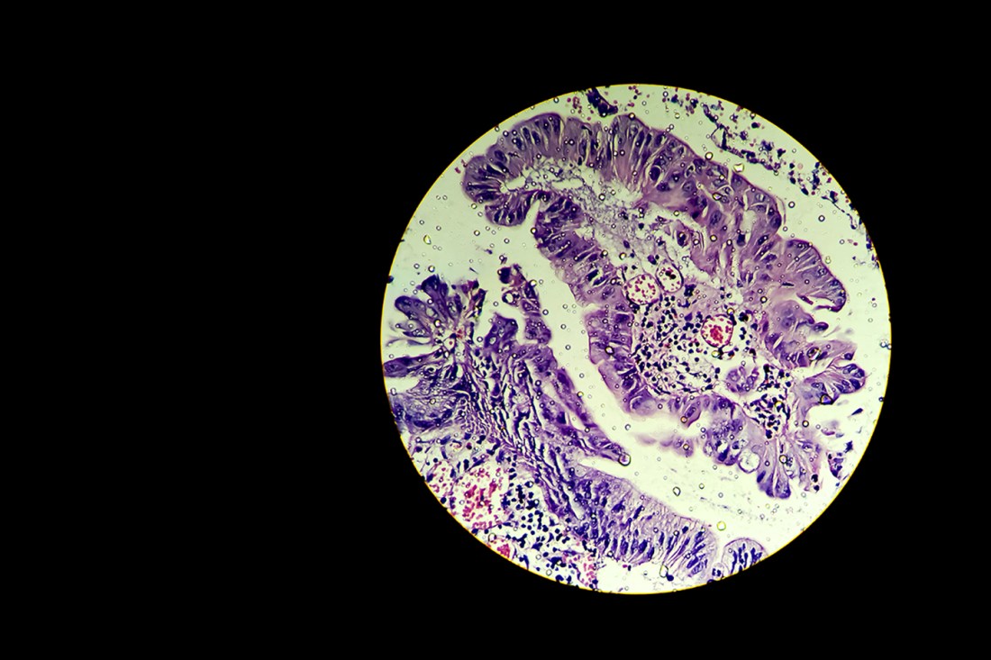 Microscopic view of ovarian cancer cells stained in purple and pink against a black background.